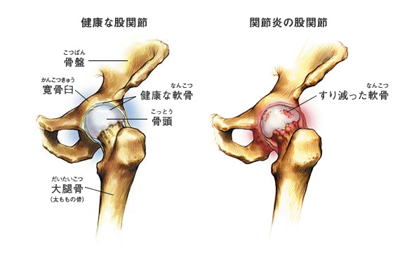 図：健康な股関節・関節炎の股関節